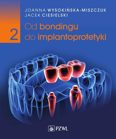 Od bondingu do implantoprotetyki cz.2