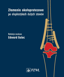Złamania okołoprotezowe po aloplastykach dużych...